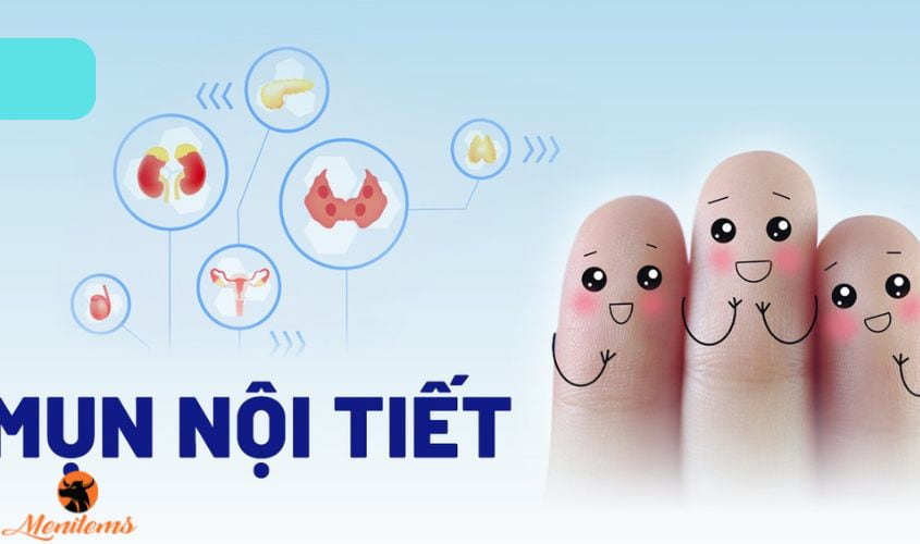 Cách trị mụn nội tiết ở nam giới hiệu quả: Giải pháp cho làn da khỏe mạnh